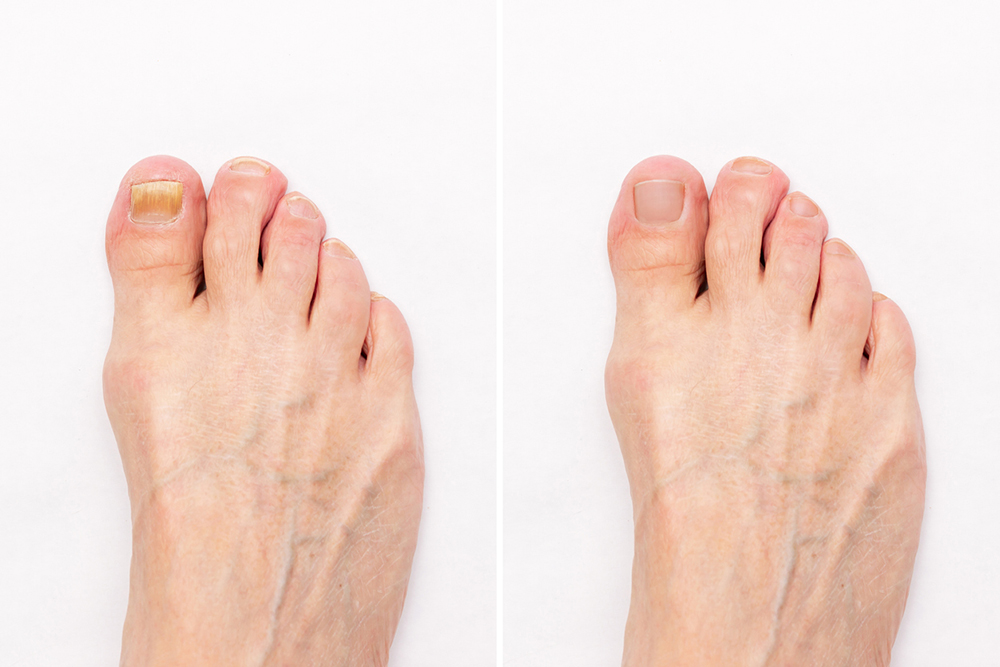 fungal laser nail treatment before after